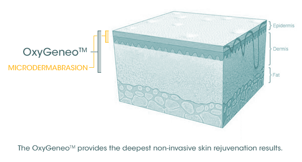 microderm-oxygeneo